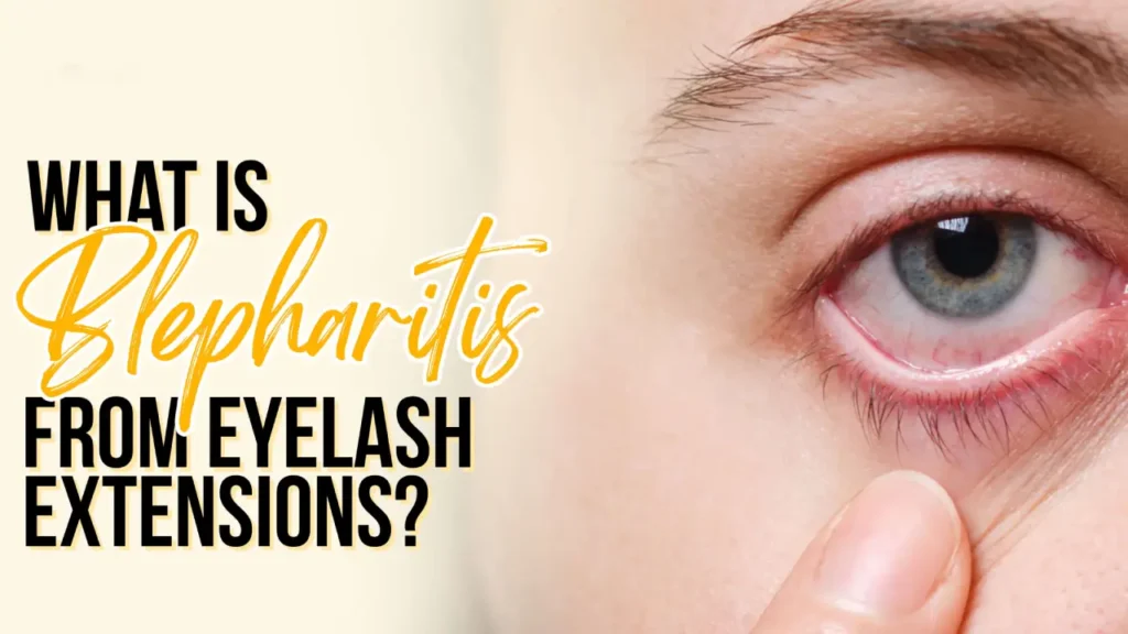 blepharitis after lash extensions