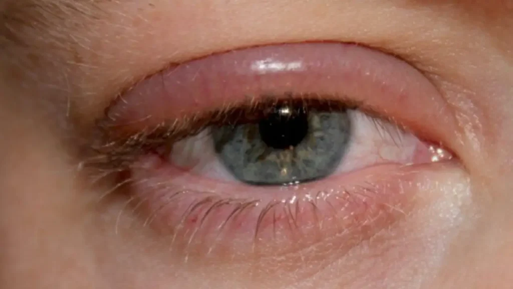 blepharitis on lash extensions