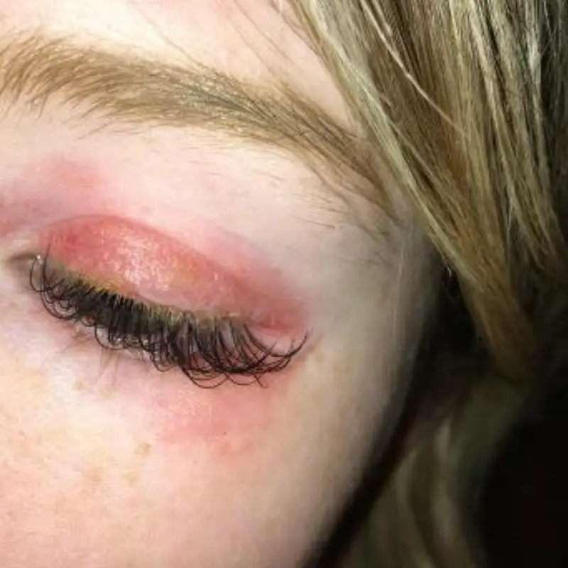 allergic reaction to lash extensions