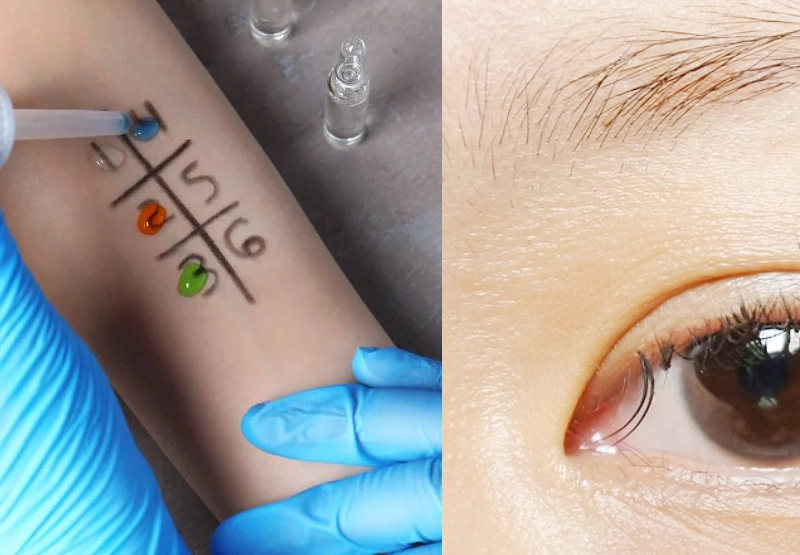 two main methods of patch testing